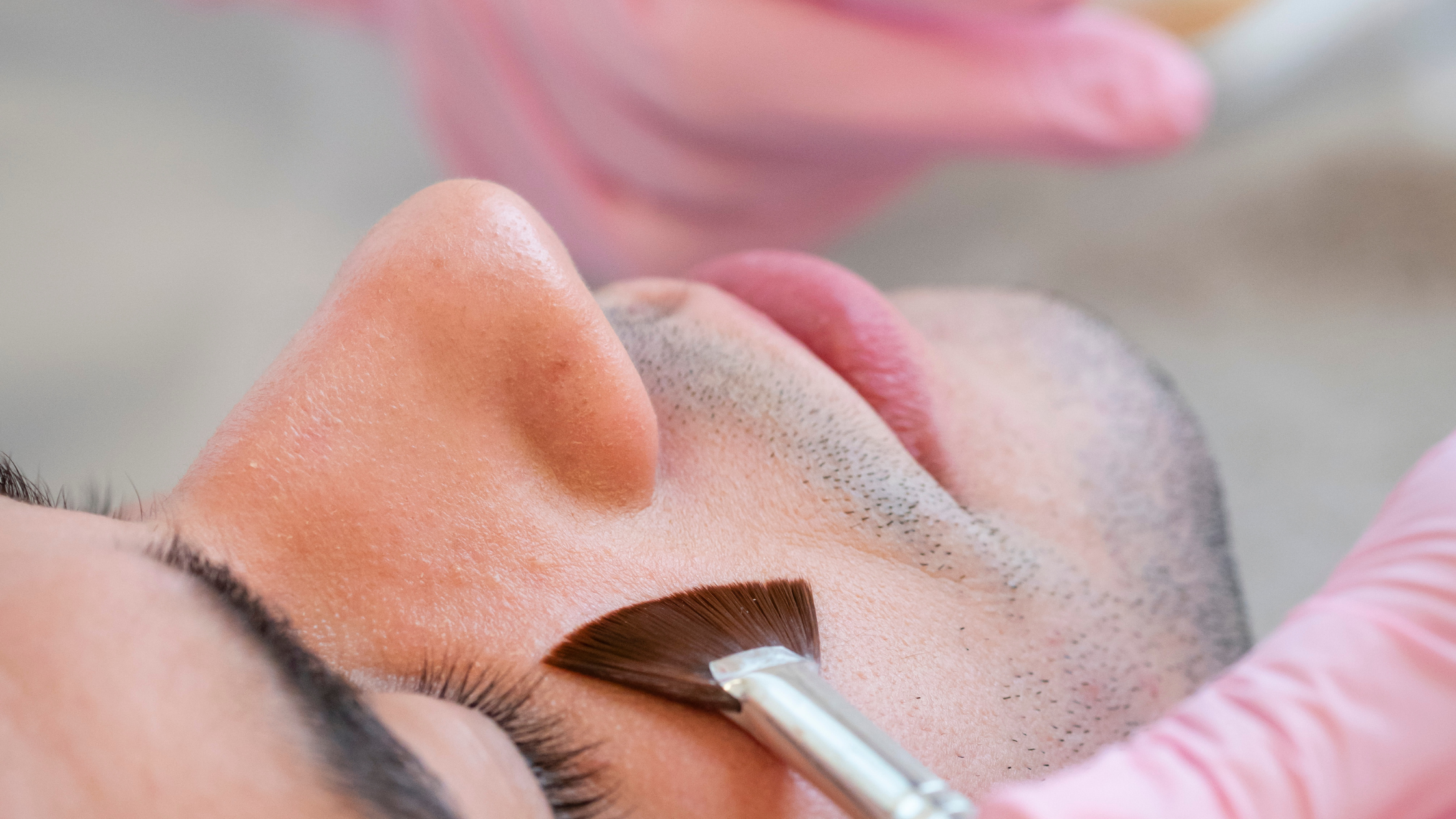 En qué consiste el peeling químico| Dra Barriga