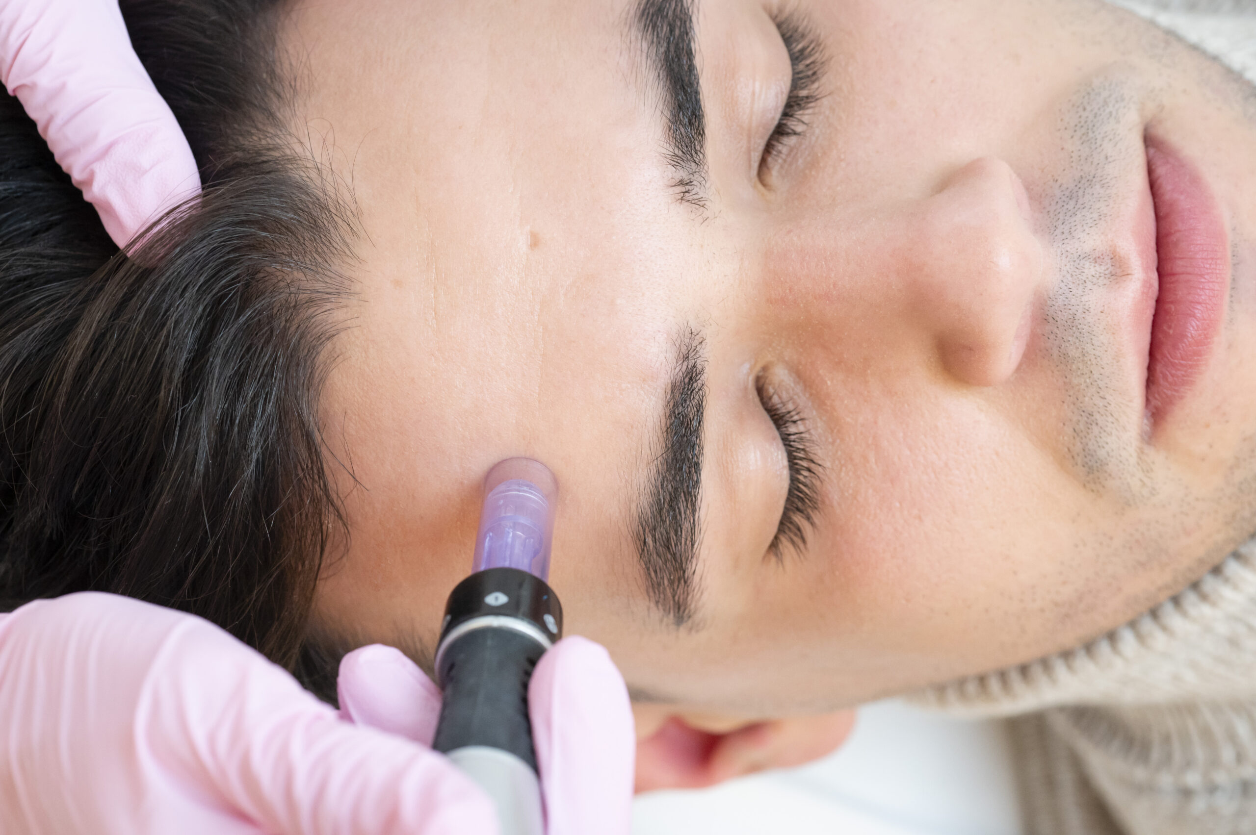 Tratamiento SkynPen en Barcelona